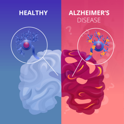 mmc - Alzheimer's disease - monoclonal antibodies - Beta-amyloid - Leqembi